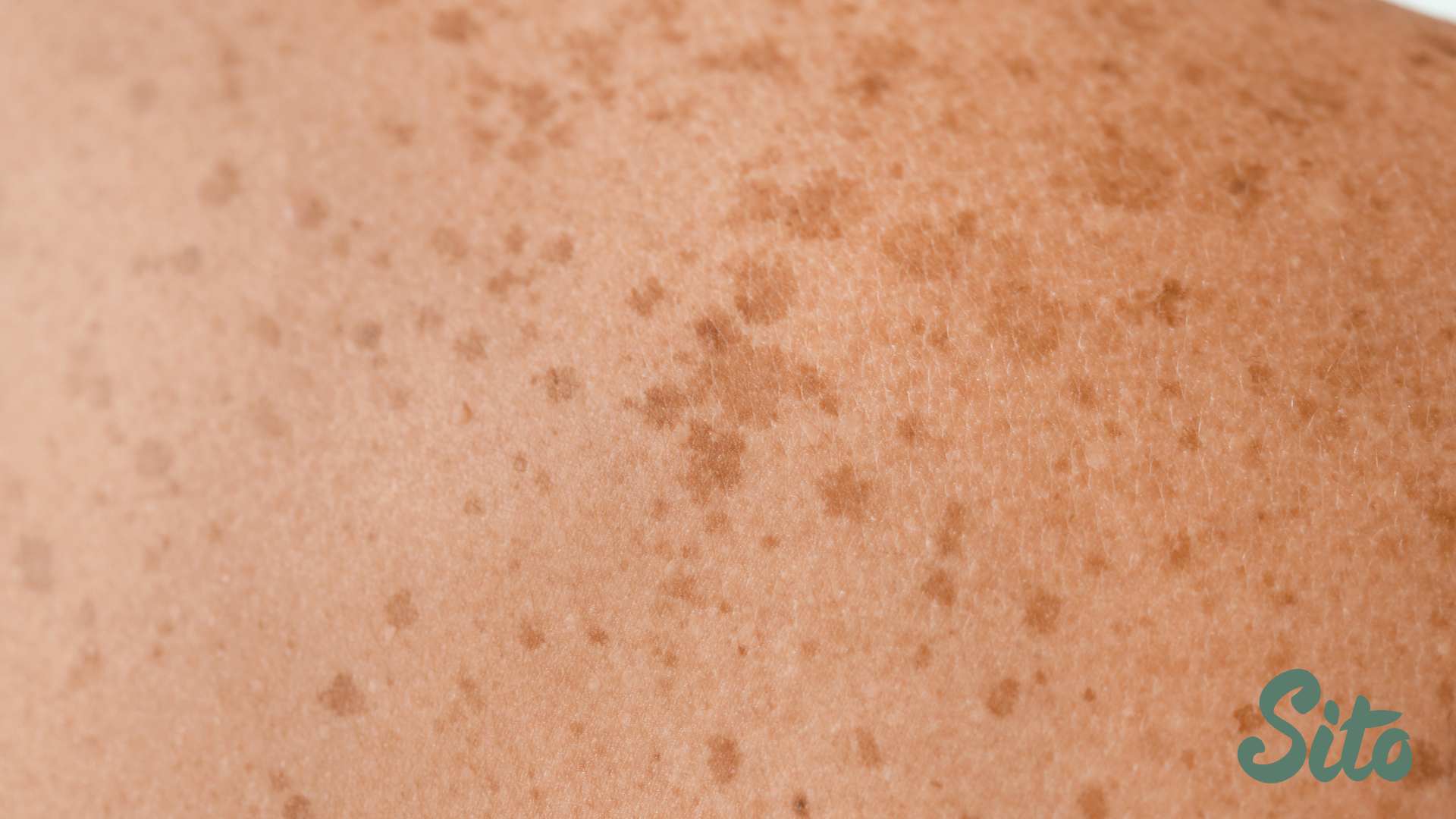 لک و تیرگی پوست